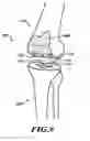 Fig. 07 - DEVICES AND METHODS FOR KNEE REPLACEMENT