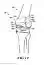 Fig. 08 - DEVICES AND METHODS FOR KNEE REPLACEMENT
