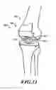 Fig. 09 - DEVICES AND METHODS FOR KNEE REPLACEMENT