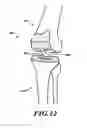 Fig. 10 - DEVICES AND METHODS FOR KNEE REPLACEMENT