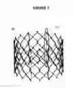 Fig. 07 - Method and apparatus for fine adjustment of a percutaneous valve structure