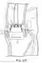 Fig. 30 - Surgical delivery device and method of use