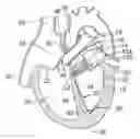 Fig. 01 - METHOD AND APPARATUS FOR RESHAPING A VENTRICLE
