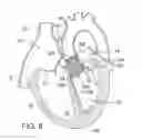 Fig. 06 - METHOD AND APPARATUS FOR RESHAPING A VENTRICLE