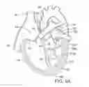Fig. 07 - METHOD AND APPARATUS FOR RESHAPING A VENTRICLE