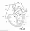 Fig. 08 - METHOD AND APPARATUS FOR RESHAPING A VENTRICLE