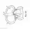 Fig. 14 - Implantable penile prosthetic having a base expandable by liquid inflation