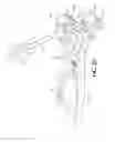 Fig. 09 - Radial head prosthesis with rotate-to-lock interface