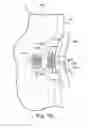 Fig. 09 - Glenoid implant anchor post
