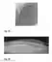 Fig. 10 - BIODEGRADABLE METAL STENT AND METHOD OF MAKING