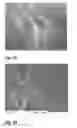 Fig. 12 - BIODEGRADABLE METAL STENT AND METHOD OF MAKING