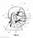 Fig. 03 - Adjustable compression garment