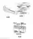 Fig. 04 - Device and method for a nanofiber wrap to minimize inflamation and scarring