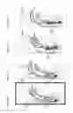 Fig. 25 - Device to reduce discomfort in the upper airway
