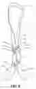 Fig. 06 - Support device for a drain system used in post-surgical procedures