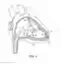 Fig. 03 - Interventional medical systems, catheters, and methods