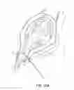 Fig. 20 - Methods for stimulating a dorsal root ganglion