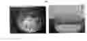 Fig. 06 - ACID SOLUBLE FLAKES AS LOST CIRCULATION MATERIAL
