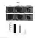 Fig. 12 - EARLY DETECTION OF PREECLAMPSIA