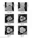 Fig. 03 - Determining an effective cross-sectional area of a cardiovascular structure