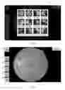 Fig. 06 - SYSTEMS AND METHODS FOR RETINOPATHY WORKFLOW, EVALUATION AND GRADING USING MOBILE DEVICES