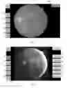 Fig. 07 - SYSTEMS AND METHODS FOR RETINOPATHY WORKFLOW, EVALUATION AND GRADING USING MOBILE DEVICES