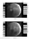 Fig. 09 - SYSTEMS AND METHODS FOR RETINOPATHY WORKFLOW, EVALUATION AND GRADING USING MOBILE DEVICES