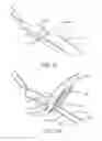 Fig. 03 - Needle electrode fixation device and associated methods