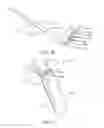 Fig. 04 - Needle electrode fixation device and associated methods
