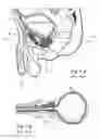 Fig. 02 - Devices, systems and methods for treating benign prostatic hyperplasia and other conditions