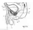 Fig. 06 - Devices, systems and methods for treating benign prostatic hyperplasia and other conditions