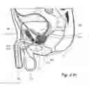 Fig. 07 - Devices, systems and methods for treating benign prostatic hyperplasia and other conditions