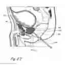 Fig. 08 - Devices, systems and methods for treating benign prostatic hyperplasia and other conditions