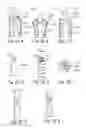 Fig. 28 - Devices, systems and methods for treating benign prostatic hyperplasia and other conditions