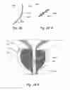 Fig. 40 - Devices, systems and methods for treating benign prostatic hyperplasia and other conditions
