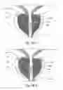 Fig. 41 - Devices, systems and methods for treating benign prostatic hyperplasia and other conditions