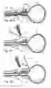 Fig. 45 - Devices, systems and methods for treating benign prostatic hyperplasia and other conditions