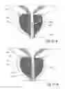 Fig. 52 - Devices, systems and methods for treating benign prostatic hyperplasia and other conditions