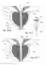 Fig. 55 - Devices, systems and methods for treating benign prostatic hyperplasia and other conditions