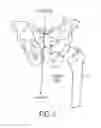 Fig. 03 - UNIVERSAL DOUBLE OFFSET SURGICAL INSTRUMENT