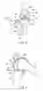 Fig. 04 - Joint surgical treatment