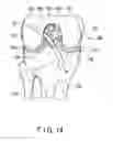 Fig. 12 - Joint surgical treatment