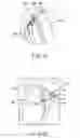 Fig. 19 - Joint surgical treatment
