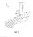 Fig. 02 - Orthopedic surgical guide