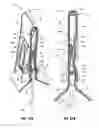 Fig. 25 - Scalpel blade remover