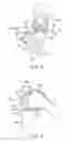 Fig. 04 - Joint surgical treatment