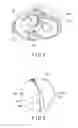 Fig. 05 - Joint surgical treatment
