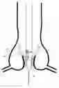 Fig. 01 - Transcatheter device for the ablation of calcified tissue at the flaps of an aortic valve