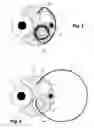 Fig. 03 - Transcatheter device for the ablation of calcified tissue at the flaps of an aortic valve