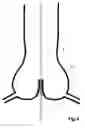 Fig. 04 - Transcatheter device for the ablation of calcified tissue at the flaps of an aortic valve